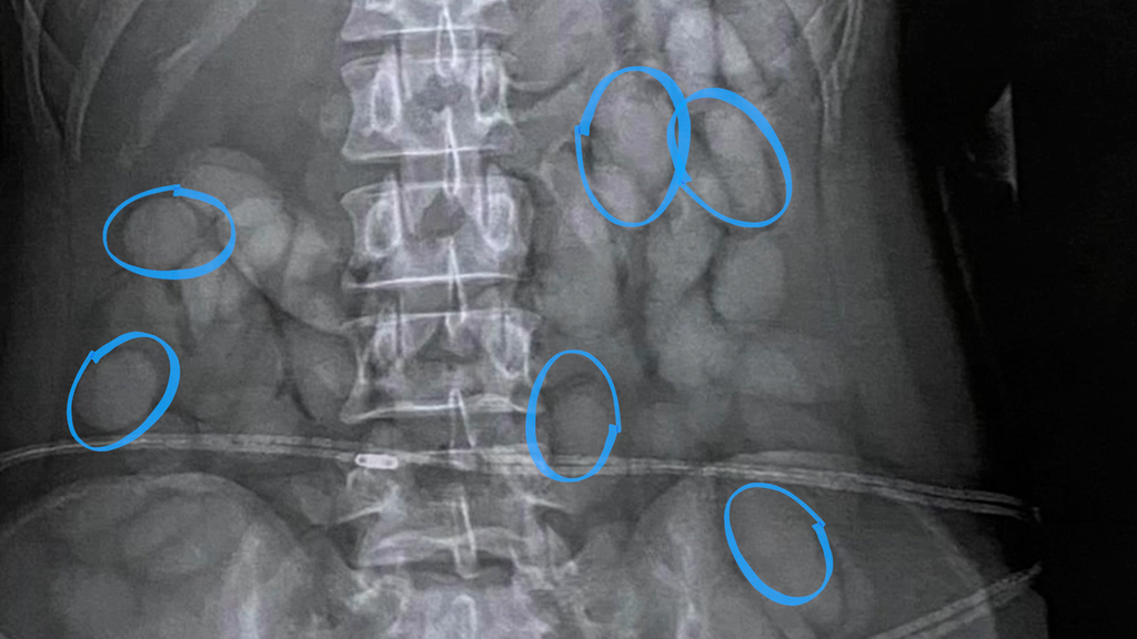 Drogenschmuggel aufgeflogen: Verdächtige mit 63 Kugeln Kokain im Magen abgefangen