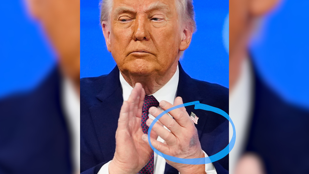 Mini giallo al WEF di Davos: da dove viene il livido sulla mano di Trump?