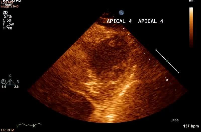 Uncommon type of tako-tsubo cardiomyopathy – Case report and current view -  ScienceDirect