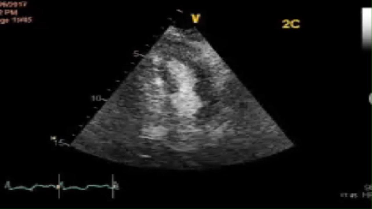 Uncommon type of tako-tsubo cardiomyopathy – Case report and current view -  ScienceDirect