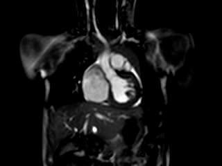 Isolated Left Ventricular Apical Hypoplasia