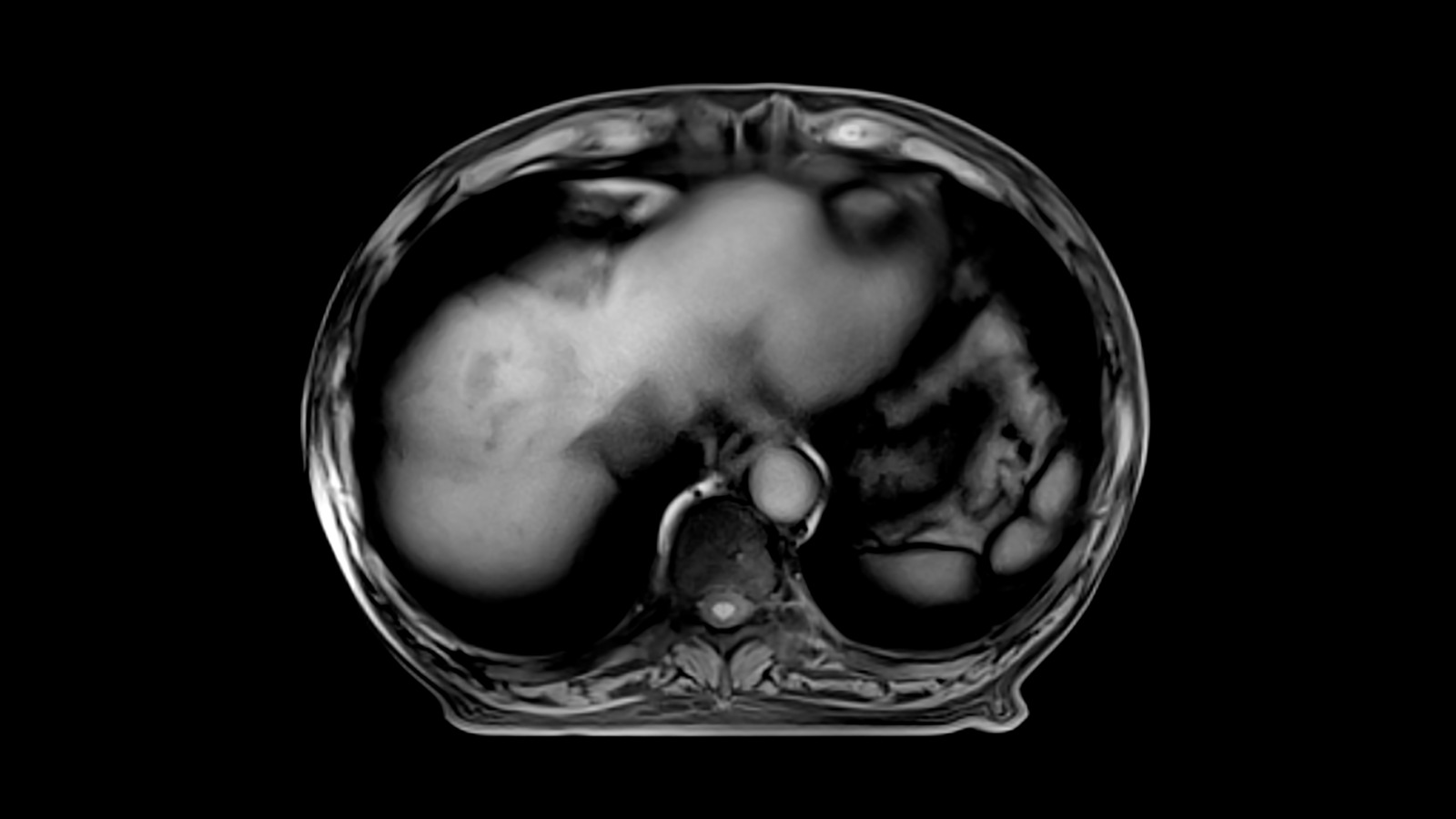 4D MRI – RT Respiratory Self-Gating - Siemens Healthineers USA