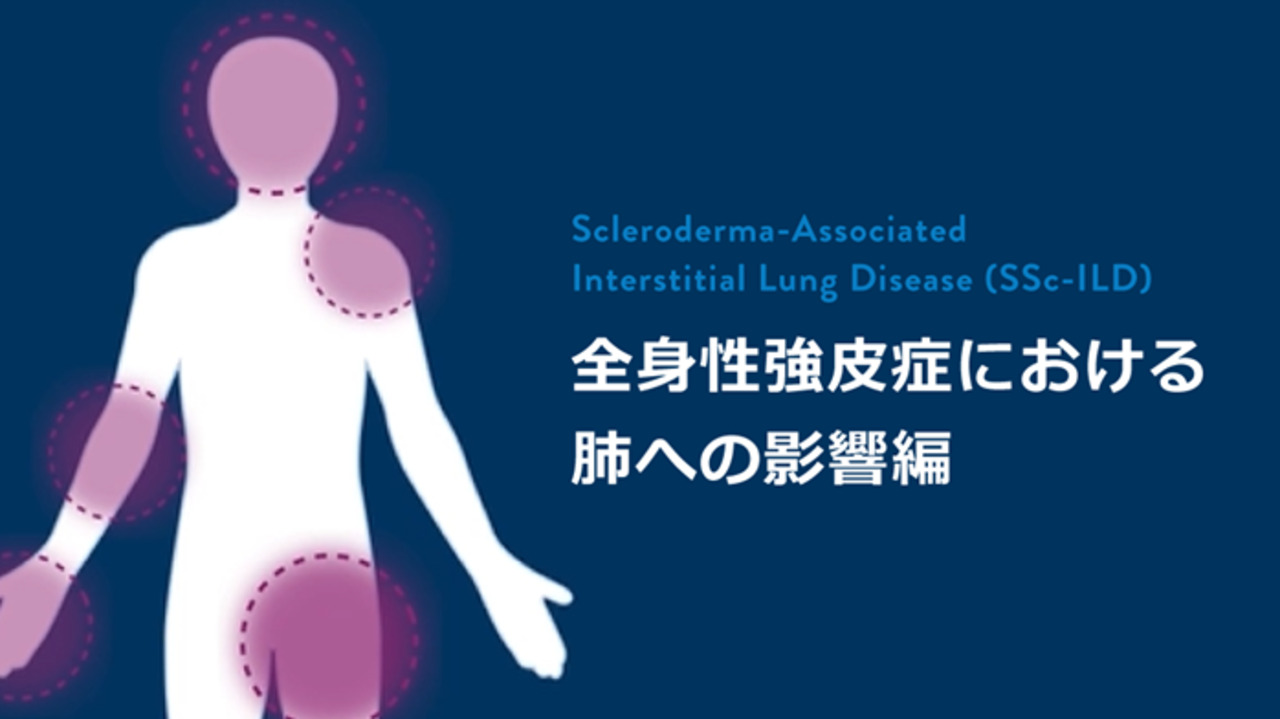 膠原病に伴う間質性肺疾患 診断・治療指針2025 日本呼吸器学会