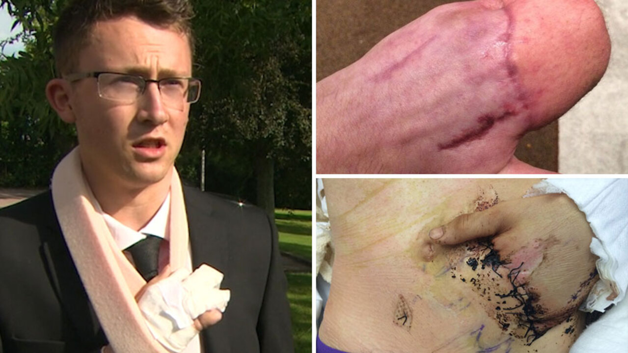 Surgeons save man's mangled hand by sewing it INTO his stomach - after it  was crushed in a machine at work