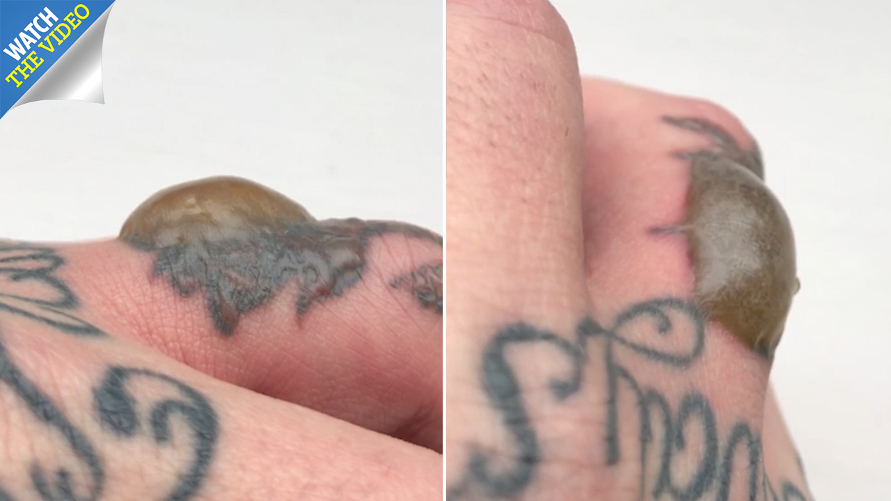 Saniderm itch after taken off? Is this normal?? : r/tattoo