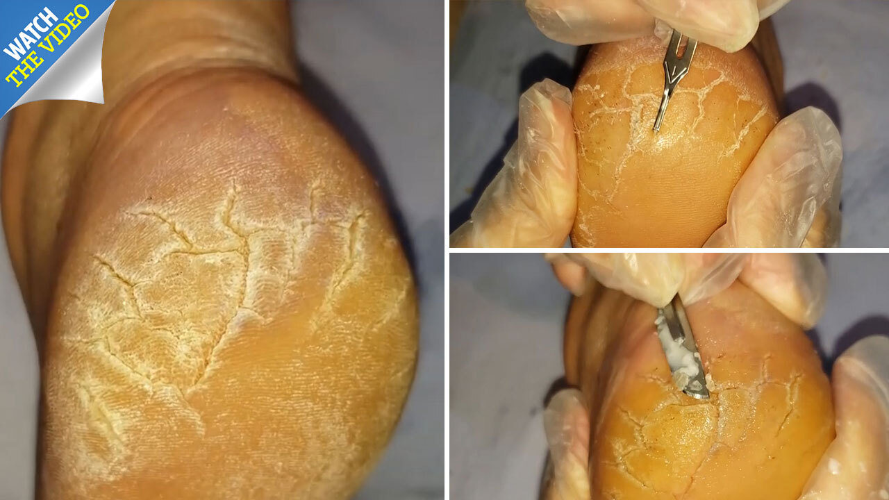 Stomach Churning Video Shows Podiatrist Hacking Stubborn Scaly Skin From Patient S Feet