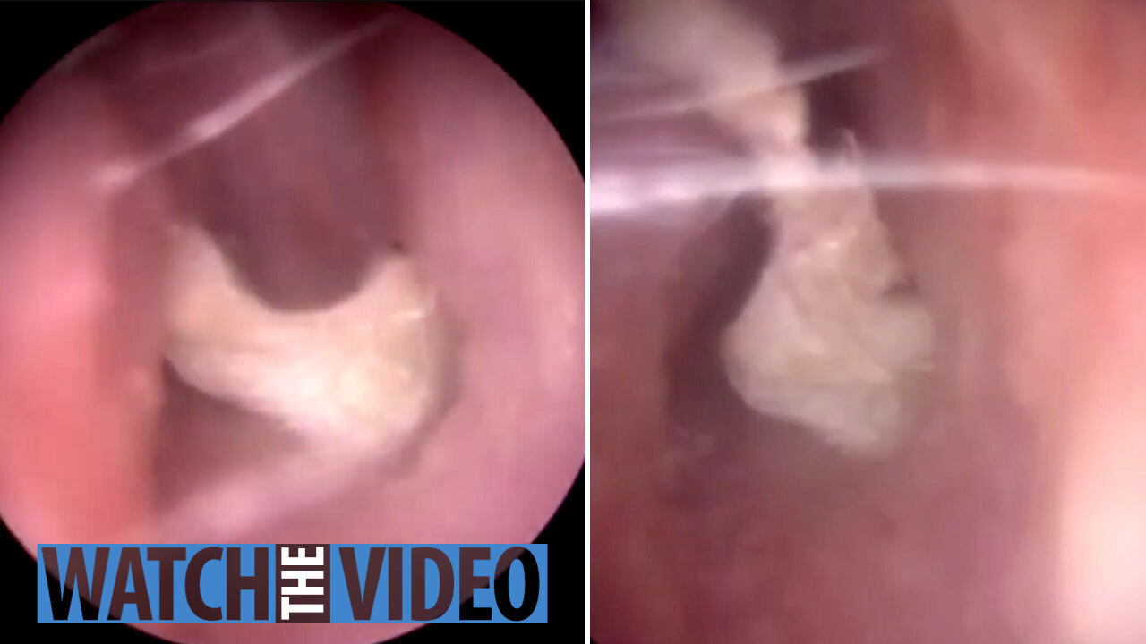 Video reveals why you should NEVER use cotton buds to clean your ears