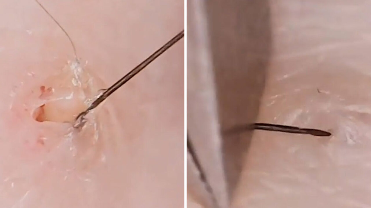 Grim Instagram Account Is Dedicated To Tweezing Out Ingrown Hairs