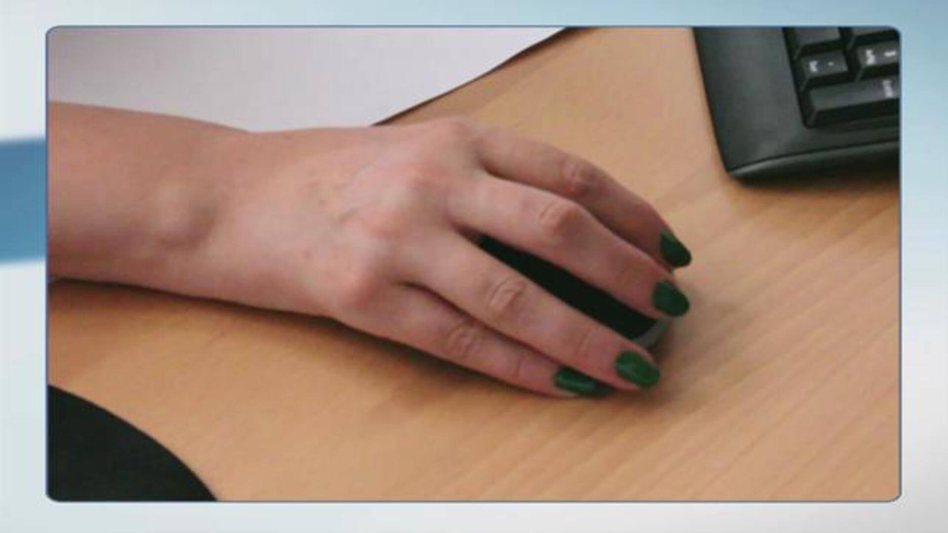 Los pacientes con artritis reumatoide tienen un mayor riesgo de trombos sanguíneos