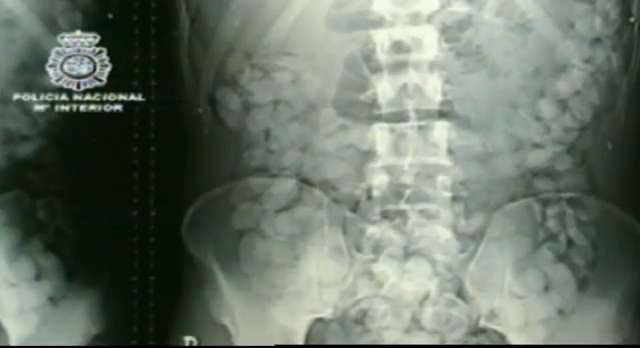 Operan a una embarazada que llevaba un kilo de cocaína en el cuerpo