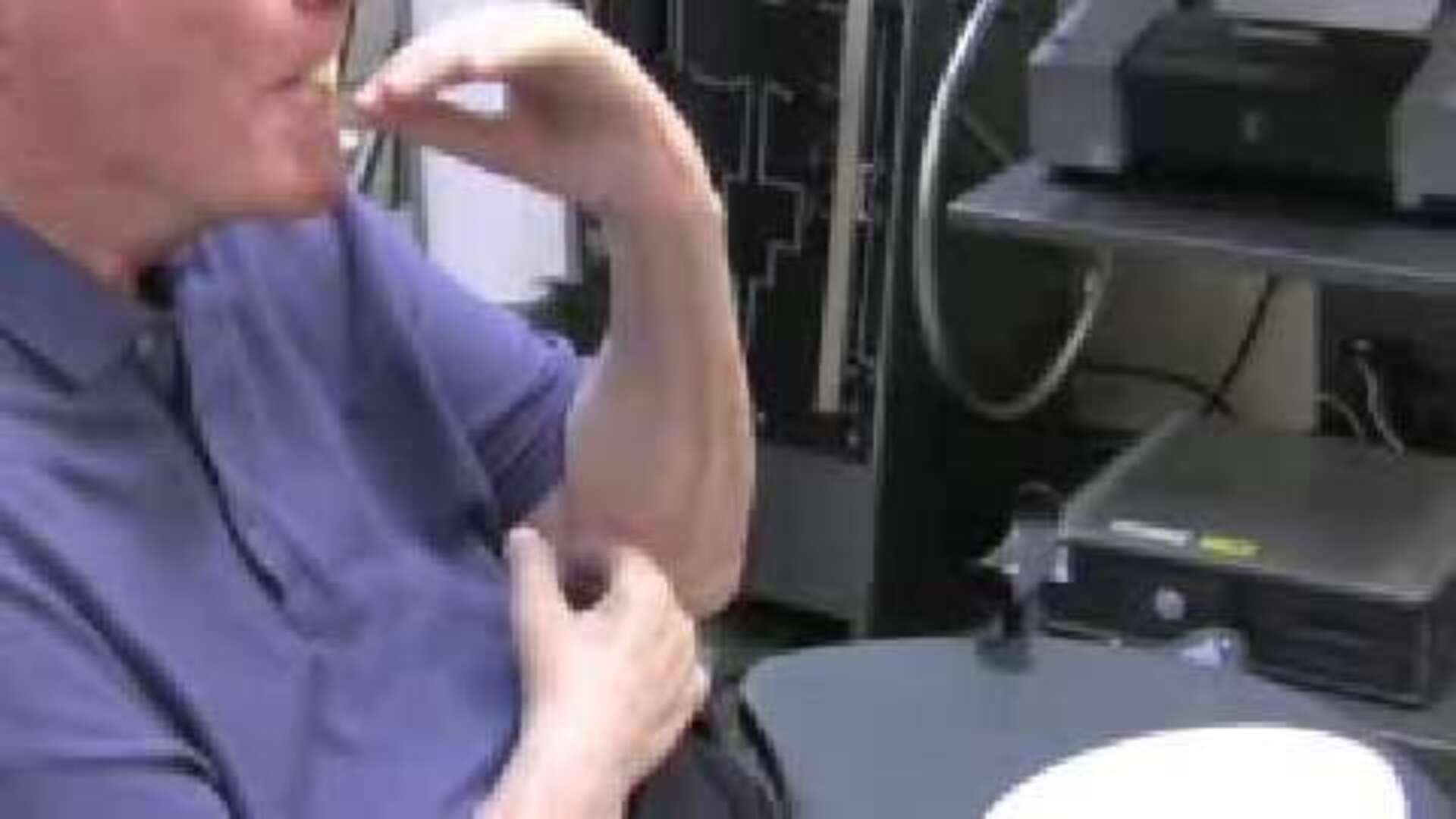 Un «bypass» devuelve la movilidad de las dos manos a un tetrapléjico