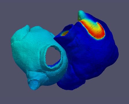 Investigadores españoles y de EE.UU. desarrollan un nuevo catéter para tratar la arritmia más común