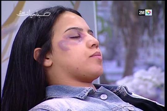La televisión pública marroquí emite un tutorial para enseñar a mujeres maltratadas a maquillarse los golpes