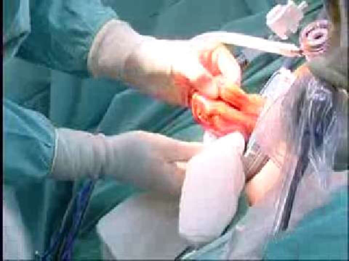 España realiza el primer trasplante de riñón en cadena entre donantes vivos