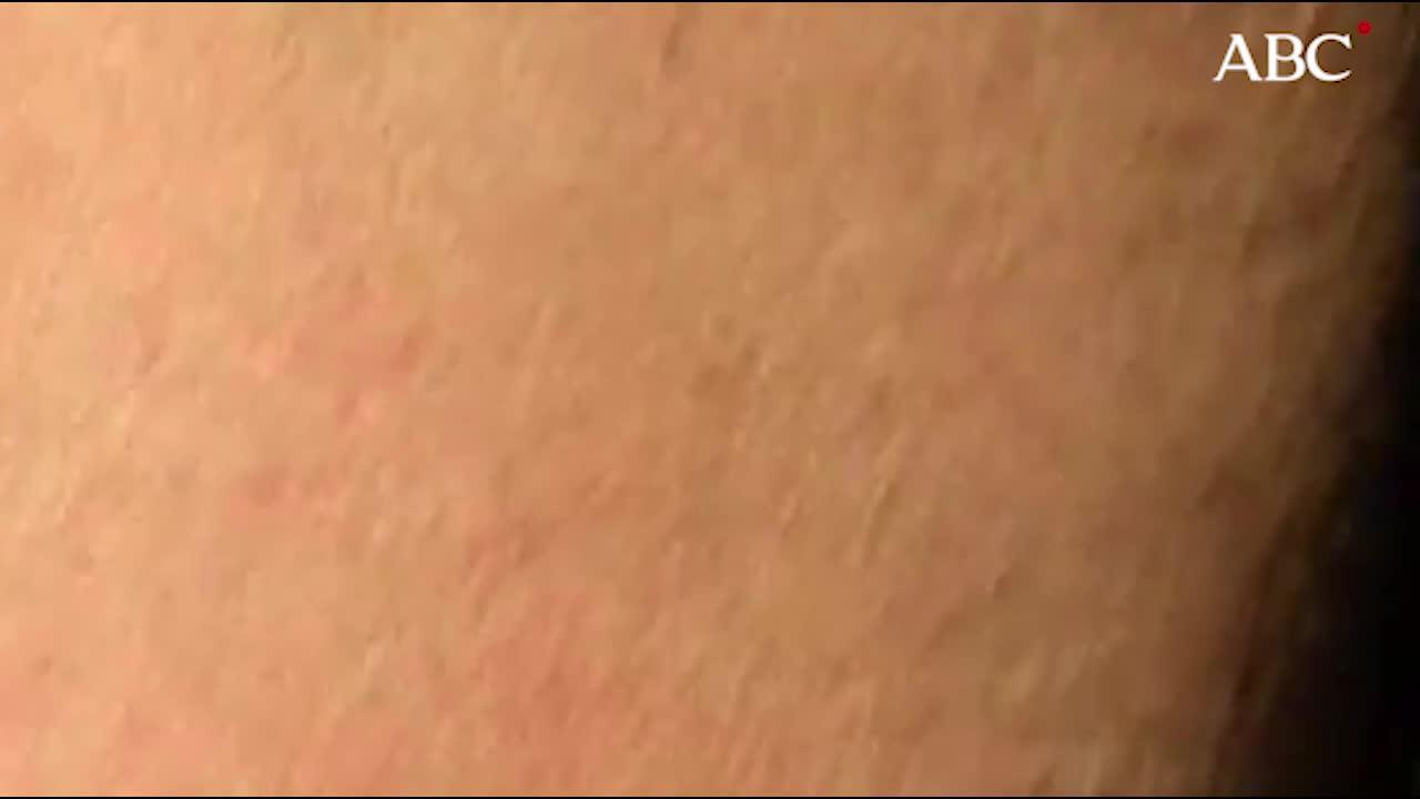 Doctor, ¿qué insecto me ha picado?