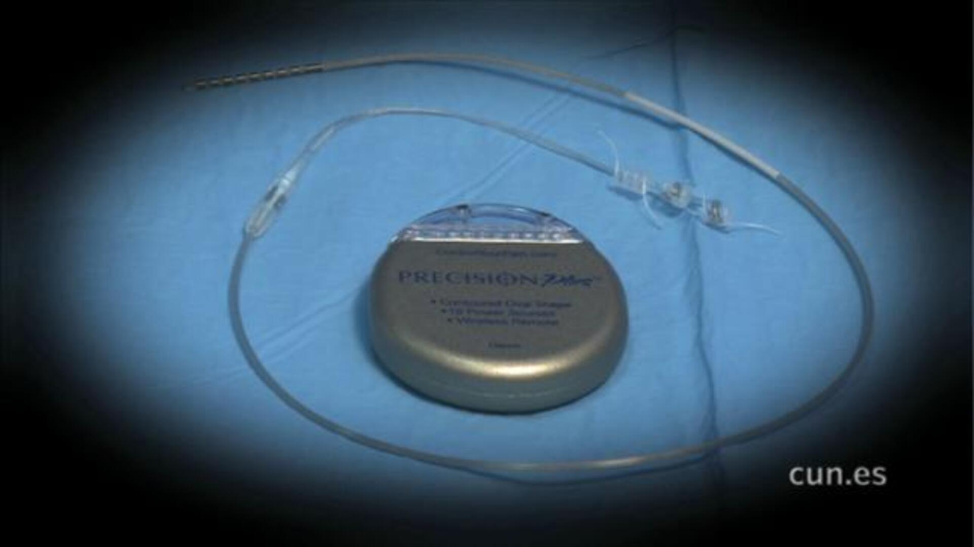 Un estimulador en el nervio vago alivia los síntomas de la insuficiencia cardiaca