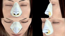 Dr. Blas García, el mejor cirujano en rinoplastia y referente mundial en la técnica de rinoplastia ultrasónica