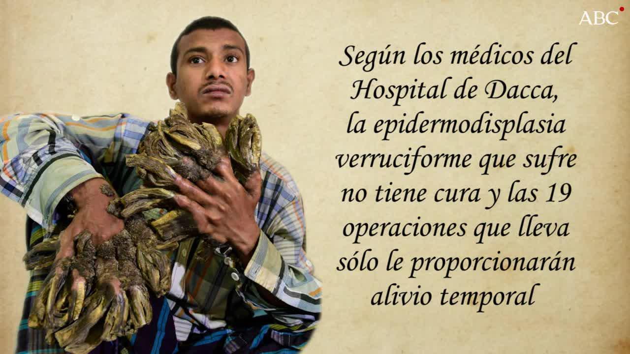 El hombre-árbol de Bangladesh pierde toda esperanza de cura