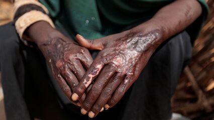Tortured, raped and traumatised: Thousands of refugees in Chad need counseling