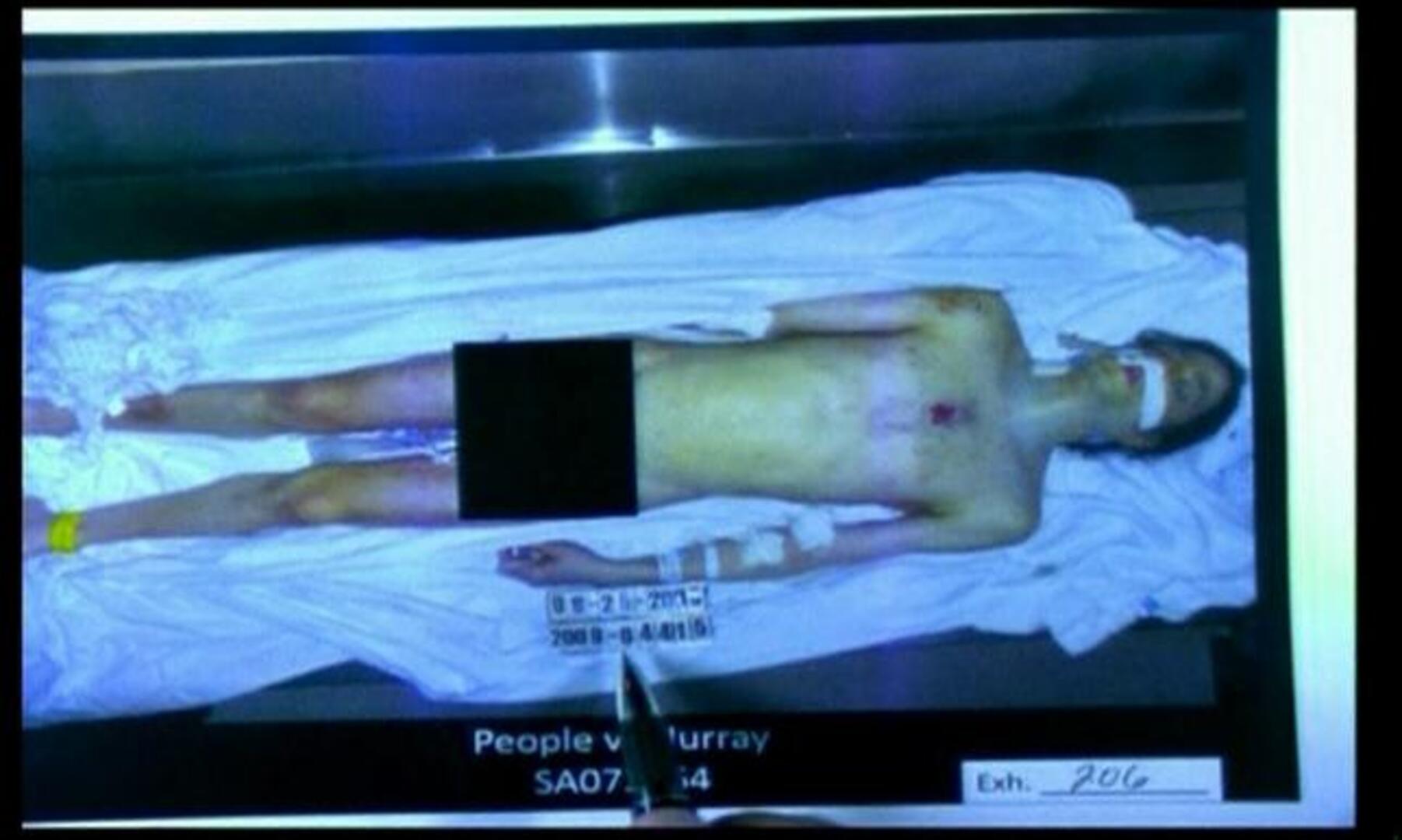 Michael Jackson era casi ciego, artrítico y sufría vitíligo