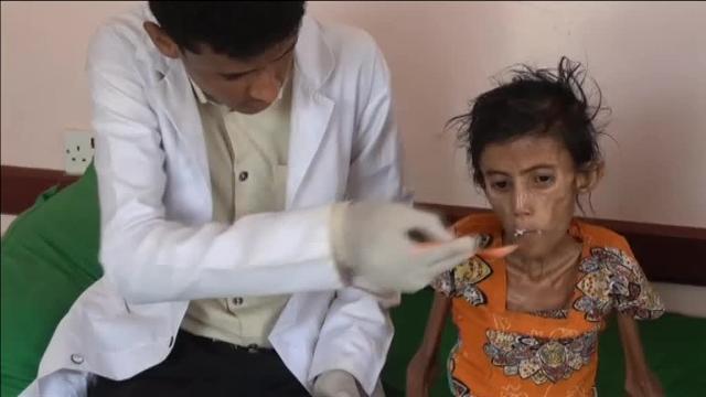 La dramática historia de una adolescente yemení que apenas pesa diez kilos y que podría morir