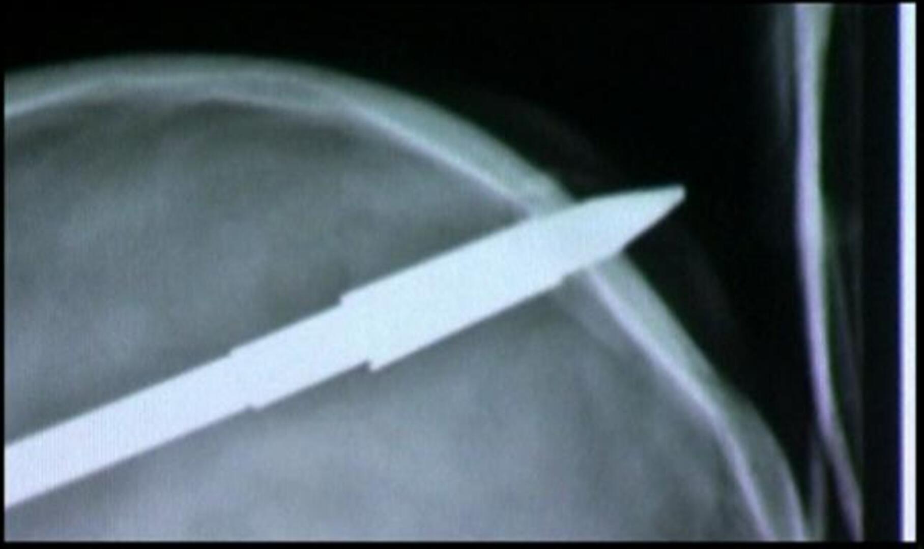 Llega al hospital con una flecha de arpón atravesándole el cráneo y se salva sin secuelas