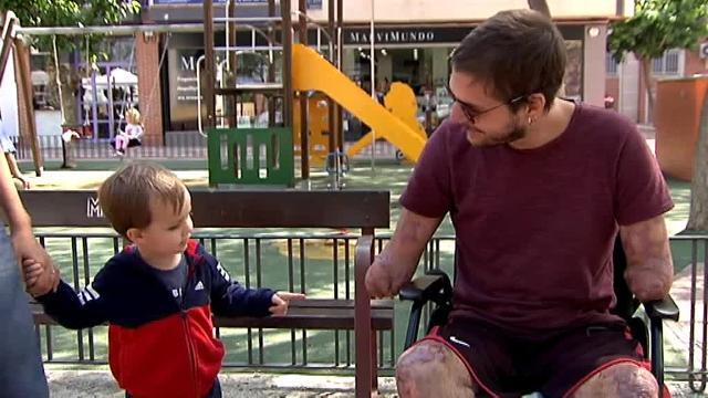 Emocionados primeros pasos de Davide Morana con las costosas prótesis financiadas por la solidaridad