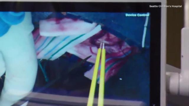 Una joven de 19 años canta mientras le quitan un tumor cerebral