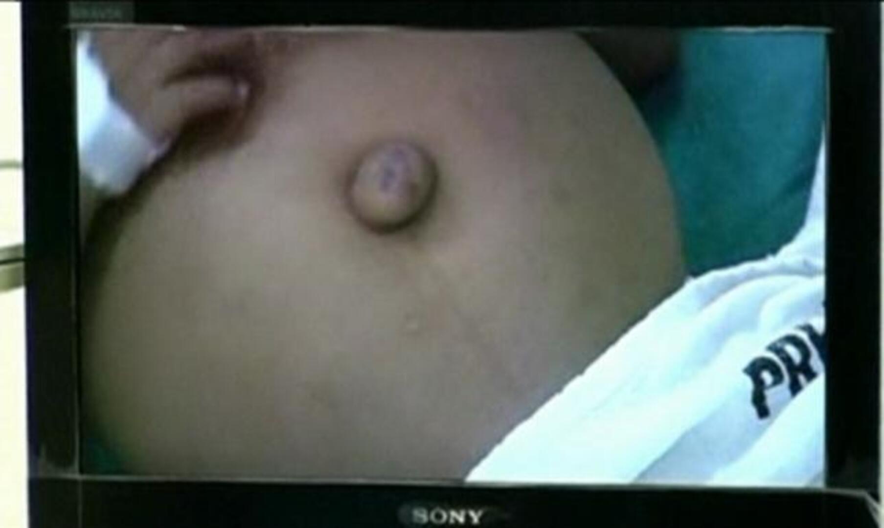 Localizan en el abdomen de un niño de tres años un feto de 700 gramos en Perú