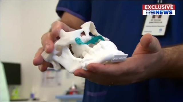 Una mandíbula en 3D cambia la vida de una enferma de cáncer