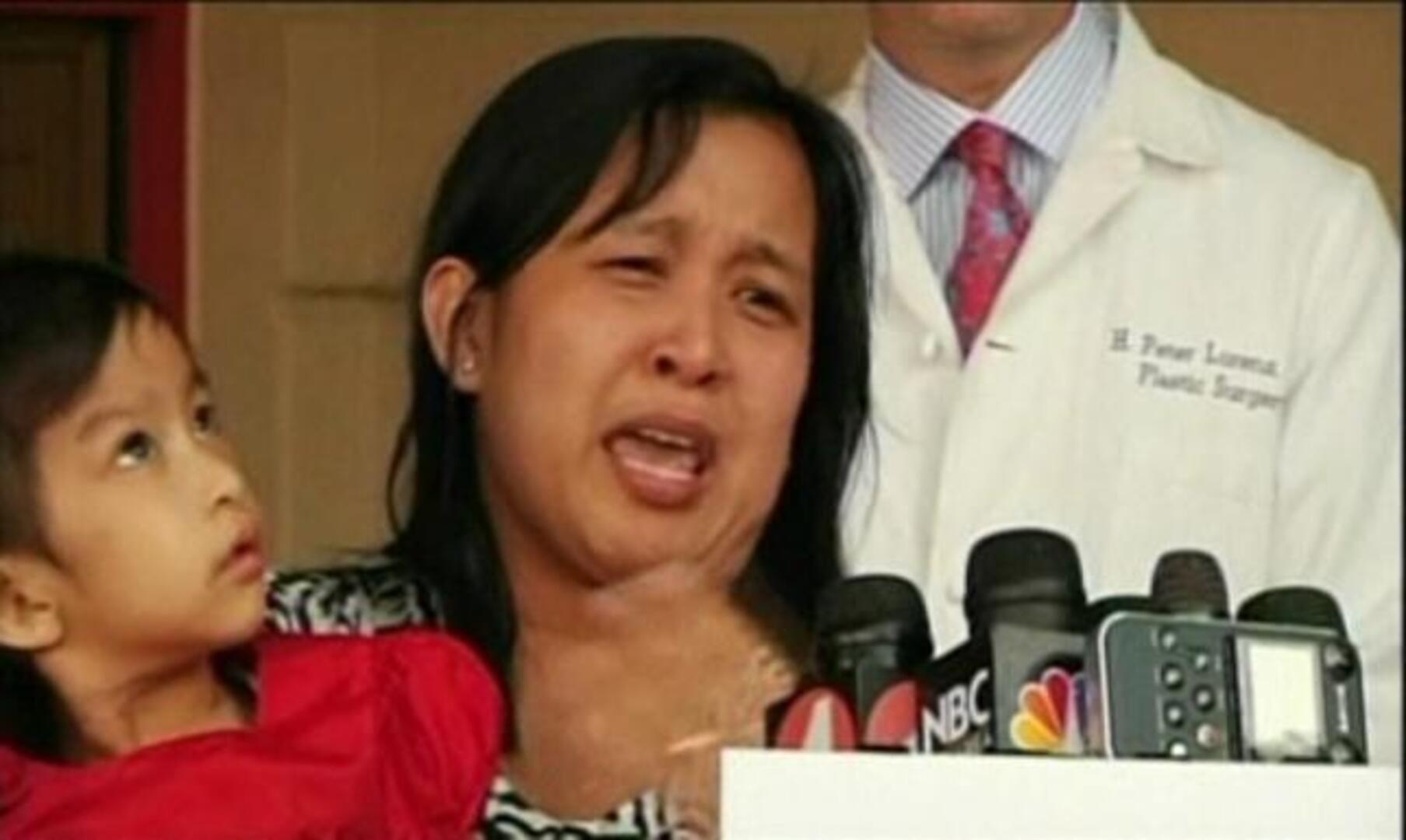 Primeras imágenes de las siamesas filipinas separadas en EE.UU.