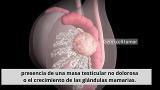 Síntomas del cáncer de testículos