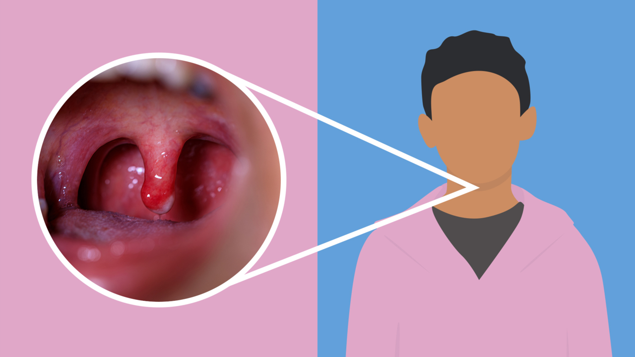 white spots on tonsils not strep